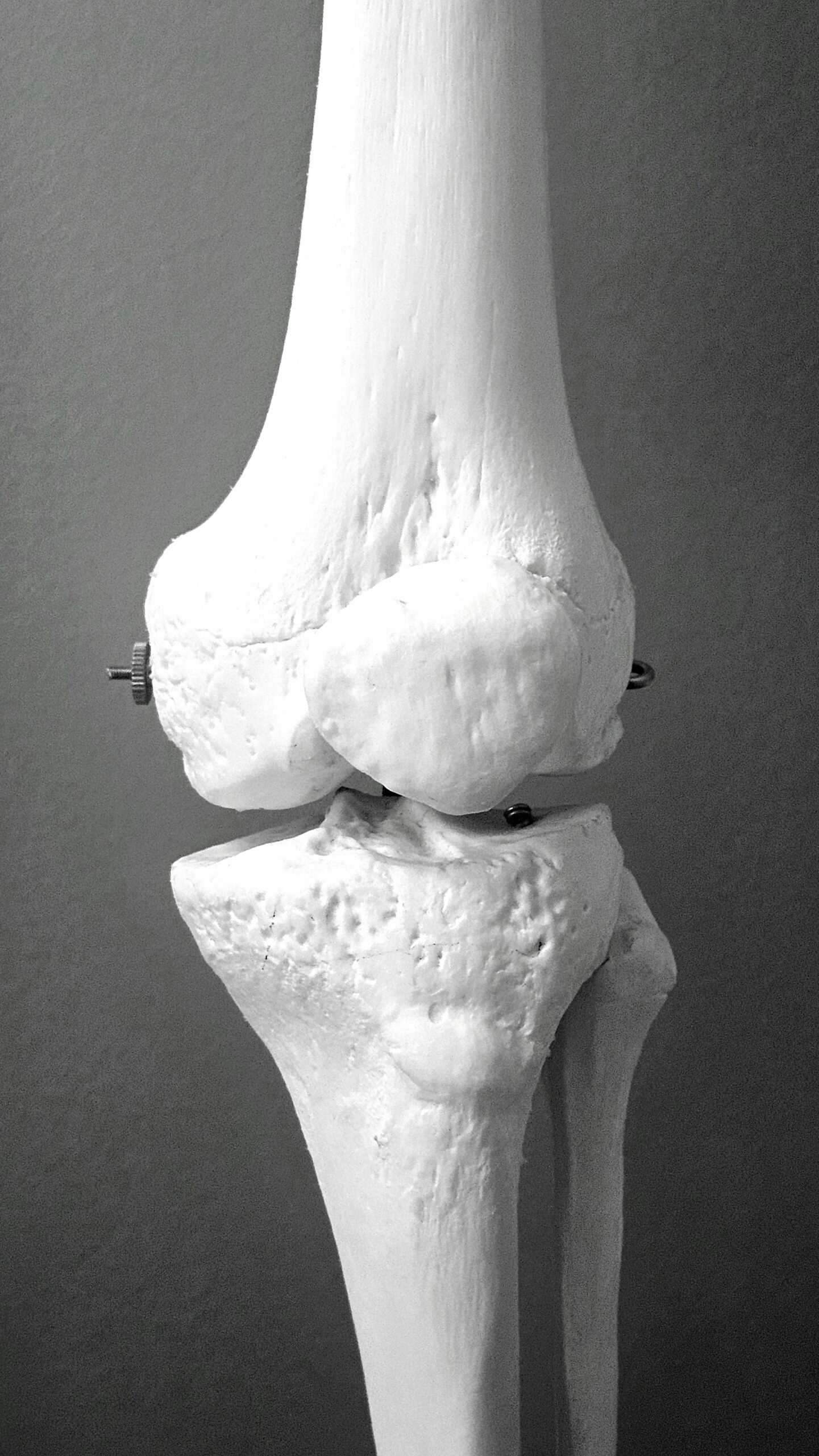 Inteligentny implant w walce z osteoporozą – przełomowy wynalazek lubelskich naukowców z Politechniki Lubelskiej i Uniwersytetu Medycznego